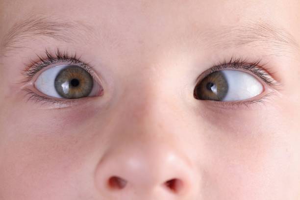 Can Strabismus Be Corrected with Vision Therapy?